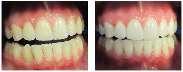 Teeth Whitening Irving, TX - Irving Family Dental
