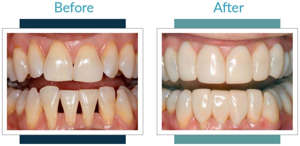 Best Dentists in Iowa Before and After 1